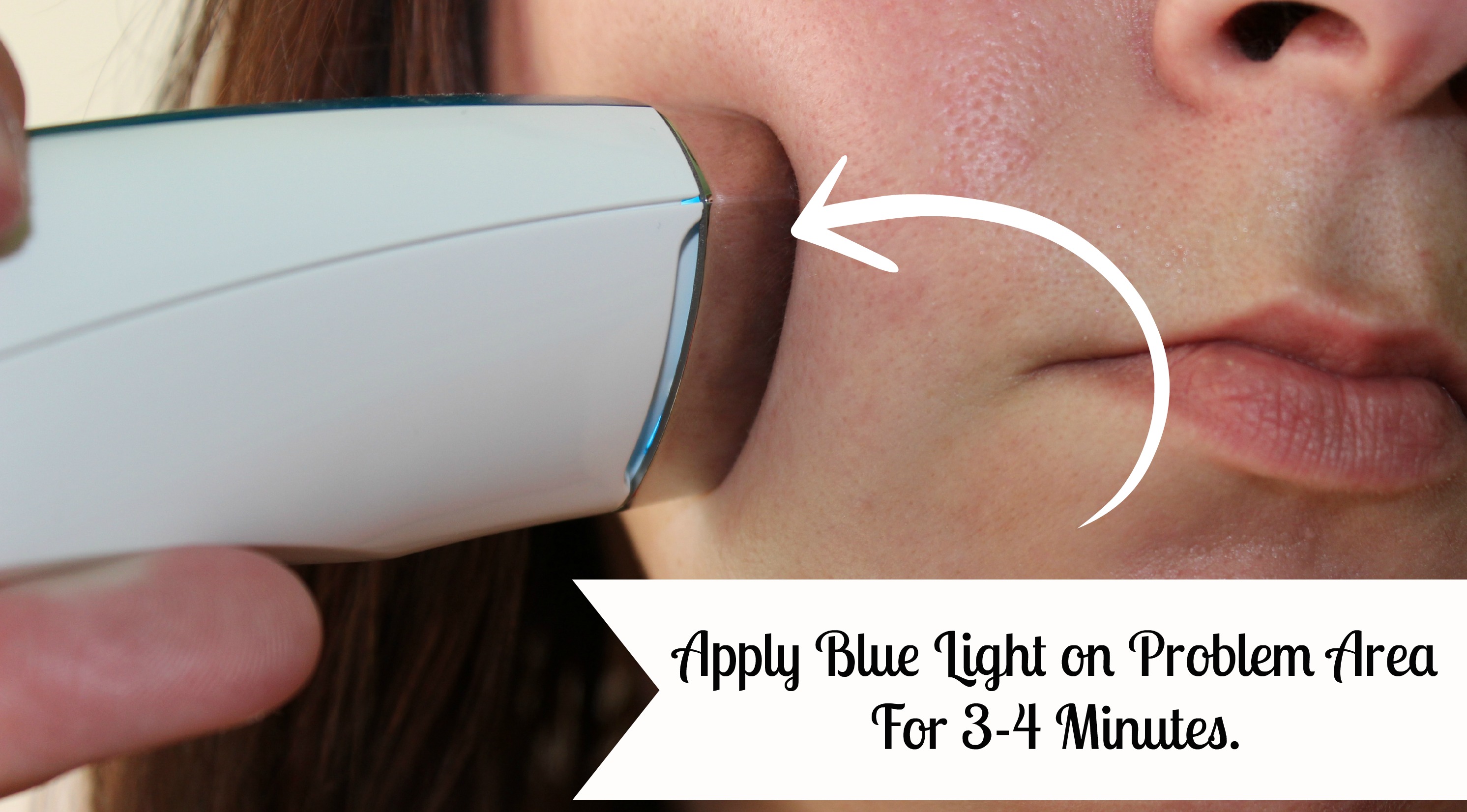 Silk'n Blue Acne Treatment Device - wide 8